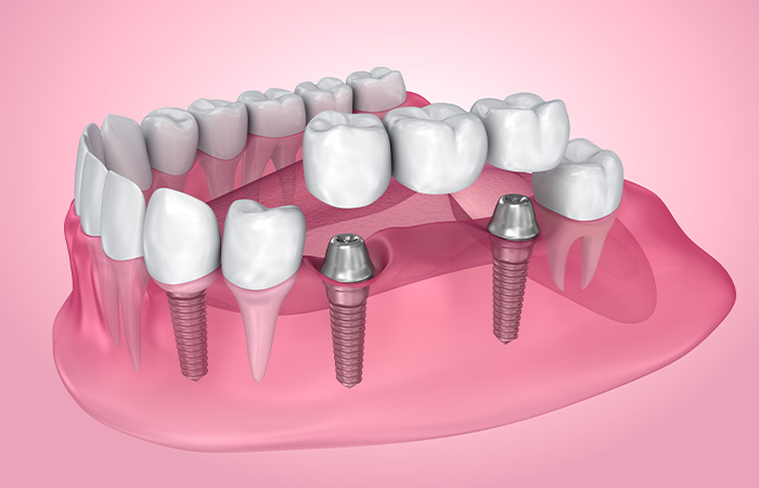 人工歯の装着